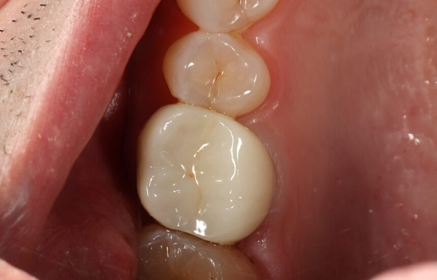 After - Brigstock Dental