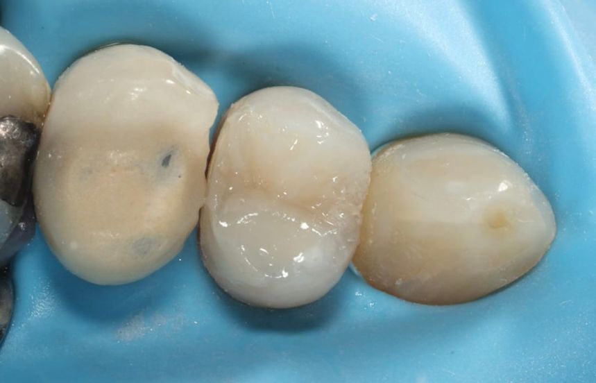 After - Brigstock Dental