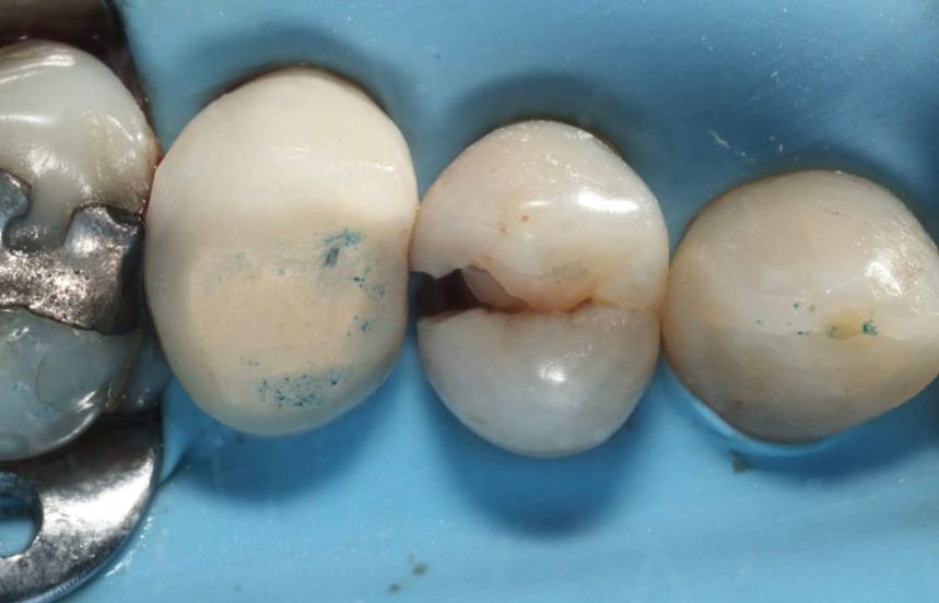 Before - Brigstock Dental