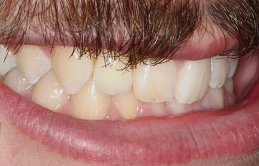 After - Brigstock Dental