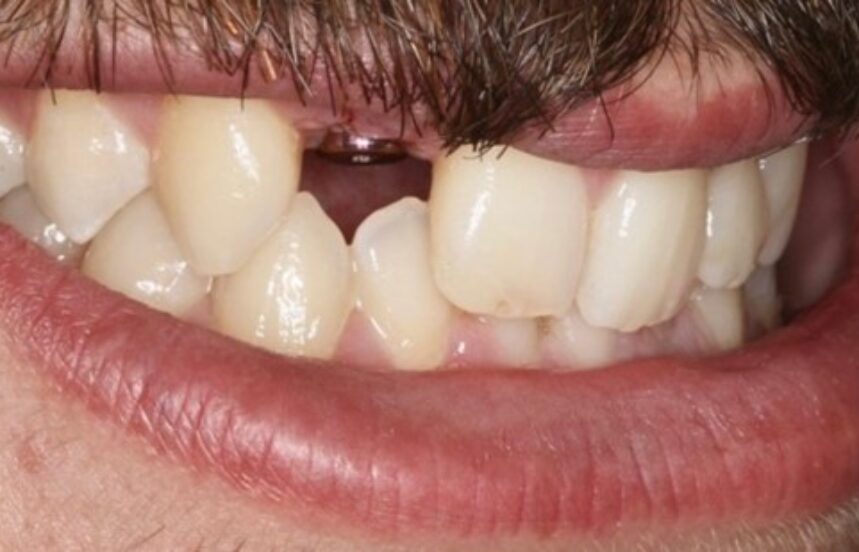 Before - Brigstock Dental