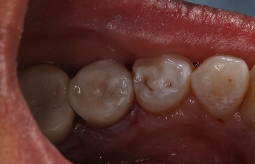 After - Brigstock Dental