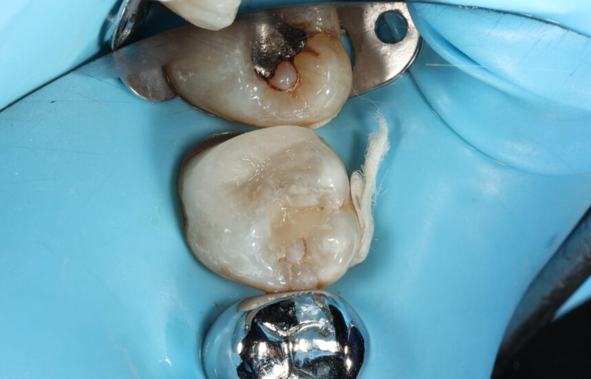 After - Brigstock Dental