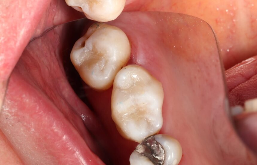 After - Brigstock Dental