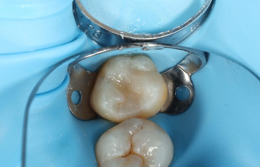 After - Brigstock Dental
