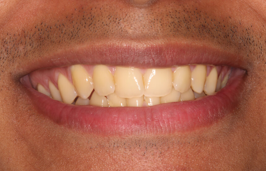 Before - Brigstock Dental
