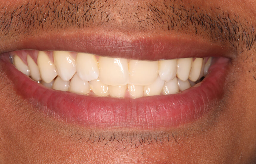 After - Brigstock Dental