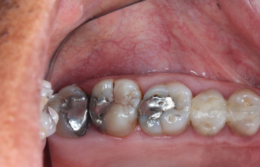 Before - Brigstock Dental