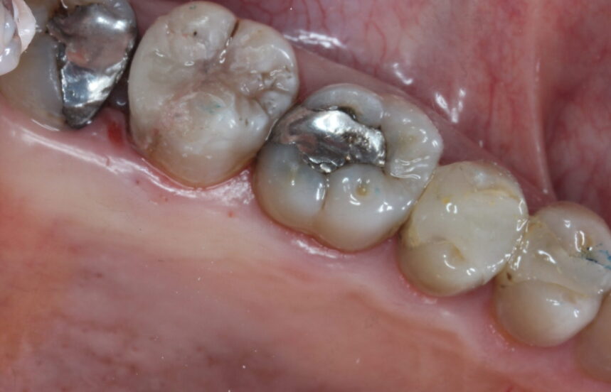 After - Brigstock Dental