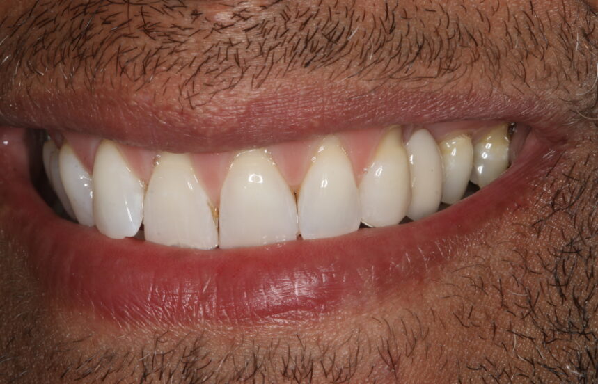 After - Brigstock Dental