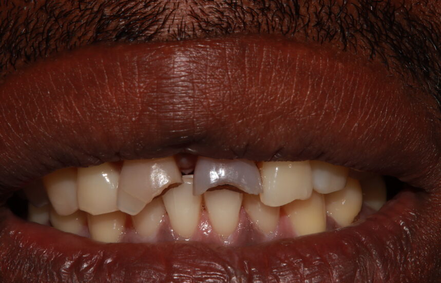 Before - Brigstock Dental