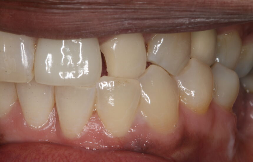 Before - Brigstock Dental
