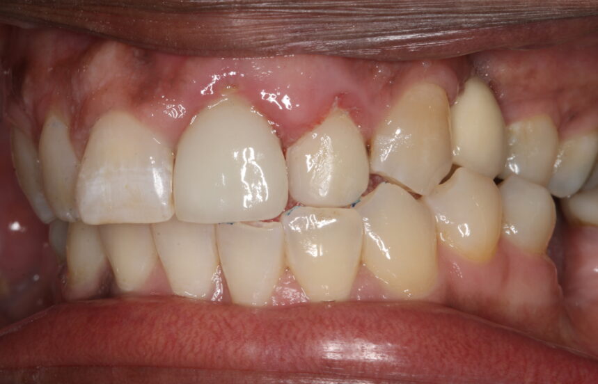 After - Brigstock Dental