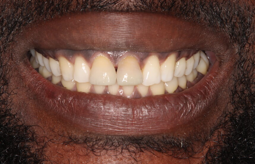 After - Brigstock Dental