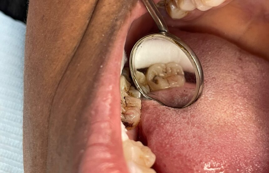 Before - Brigstock Dental