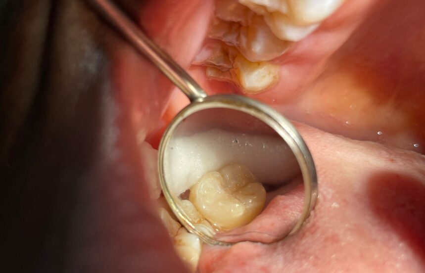After - Brigstock Dental