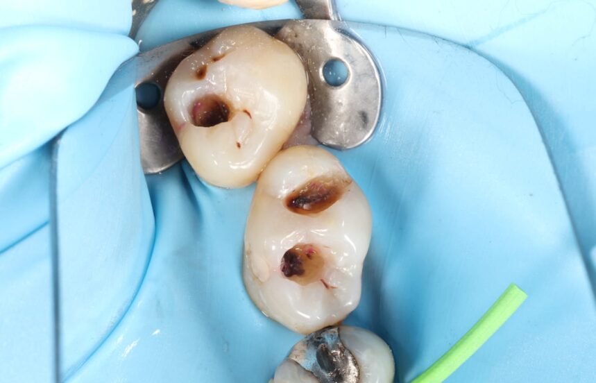 Before - Brigstock Dental